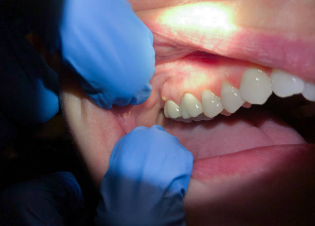 Best Knocked-Out Tooth Emergency  in Calcium, NY